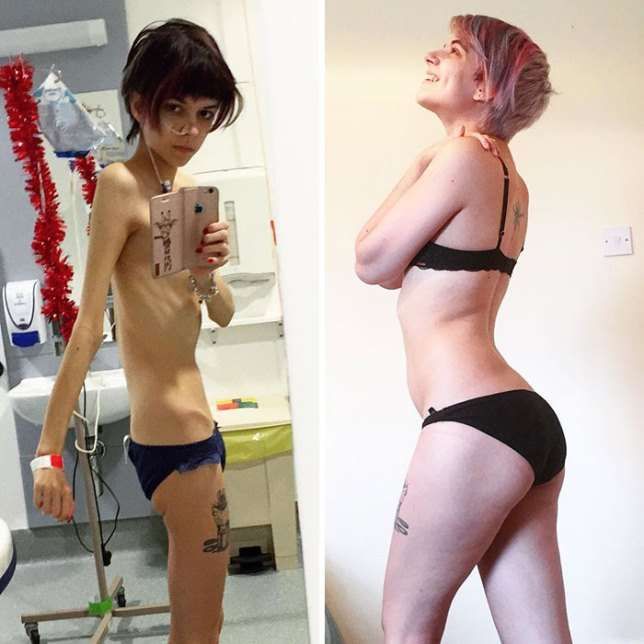 30 Людей, победивших анорексию: фото до и после